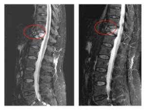 Ejemplo caso clínico cifoplastia