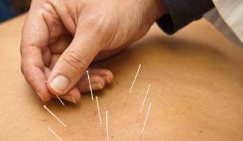 acupuntura
