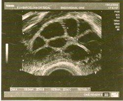 Ecografía-tratamiento-FIV-ICSI