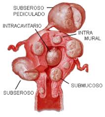 foto 2 -miomas uterinos