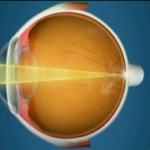 Oftalnova-oftalmologos-barcelona-refraccion-ojo-normal-emetrope-150x150