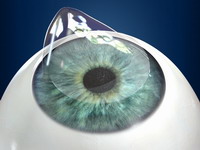 Creación flap corneal (LASIK)