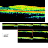 OCT-prueba-diagnostica-oftalmologia-oftalnova-barcelona-200x200