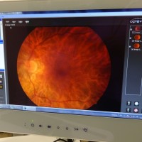 Retinografia-pruebas-medicas-oftalmologia-oftalova-Barcelona-1-200x200