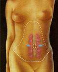 Aproximación de la musculatura abdominal