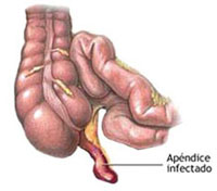 Apendicitis