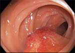 cáncer colon y recto
