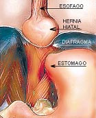 Hernia hiato