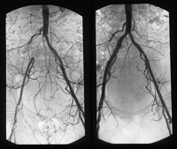 Cirugía endovascular_