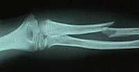 Traumatismos del antebrazo_02