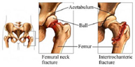 Fracturas de tercio superior del fémur
