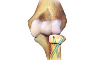 Fracturas de cabeza de radio