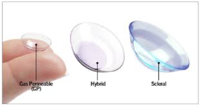 cornea irregulares