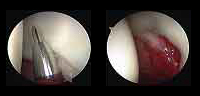 Imagen con artroscopia de entrada de instrumentos para la cirugía