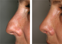 Rinoplastia_01