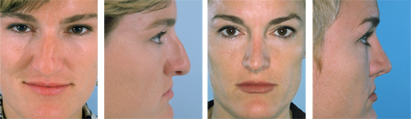 Rinoplastia_04