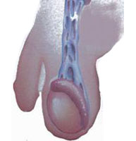 varicocele