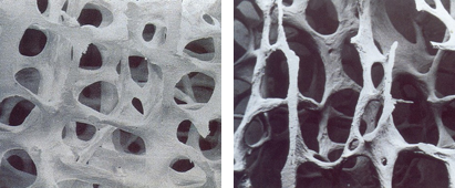 Osteoporosis