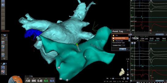 Electrofisiologia i Arritmias destacada. This link opens in a popup window