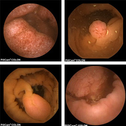 Cápsula colon