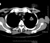 Biopsia tórax guiada por TC