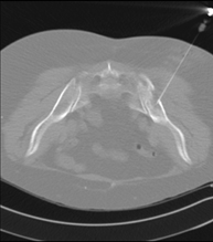 Biopsia ósea guiada por TC