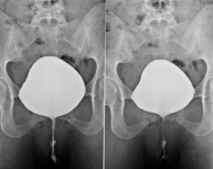 Cistografía (CUMS)