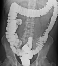 Enema opaco