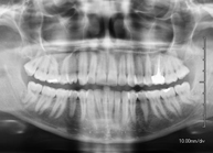 RX Ortopantomografía