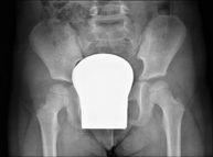 RX Caderas