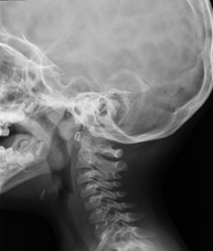 RX Cavum