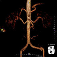 Angio-RM Aorta Abdominal
