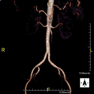 Angio-RM Aorta ilíaca