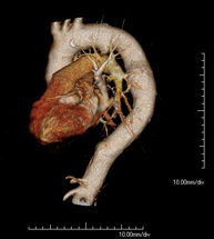 Angio-TC Aorta torácica