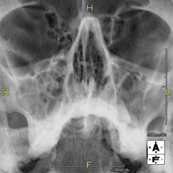 RX Huesos propios nasales