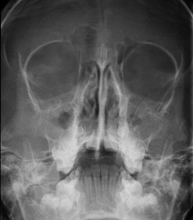 RX Senos paranasales