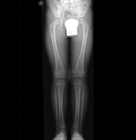 Telemetría EEII (Extremidades Inferiores)