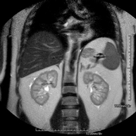 RM Glándulas Suprarrenales