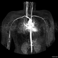 Angio-RM extremidades superiores