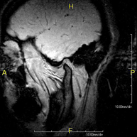 RM ATM (Articulación Temporo-Mandibular)