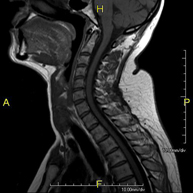 RM Columna cervical