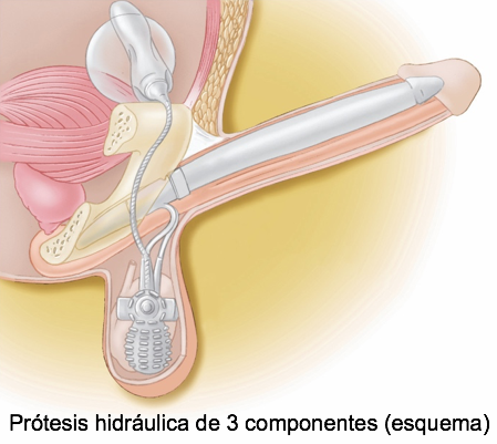 protesis de pene
