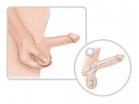 Implantes o Prótesis de pene