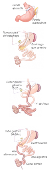 Técnicas quirúrgicas de la cirugía de la obesidad