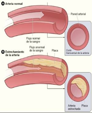 Aterosclerosis