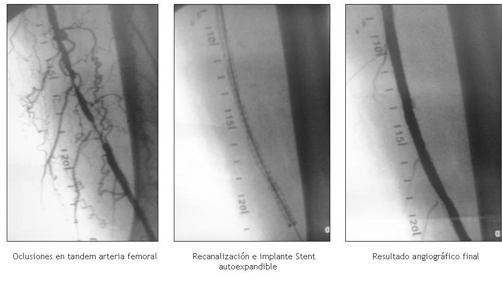 Recanalización femoral izquierda con Stent