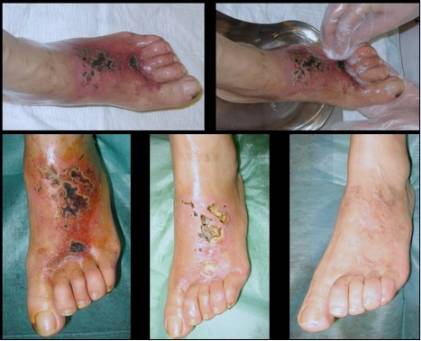 ulceras diabéticas salvamiento de extremidades