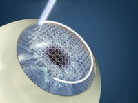 Creación de flap corneal