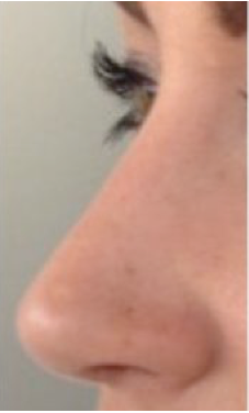 Rinoplastia Teknon