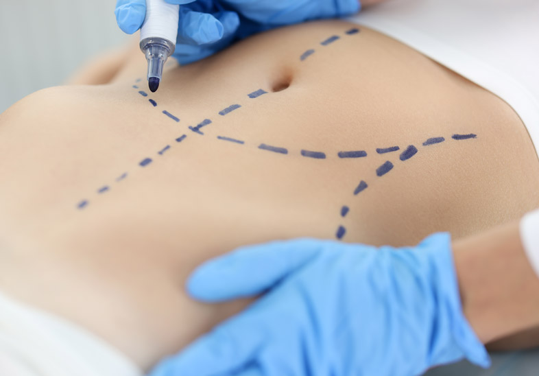 Lipotransferencia